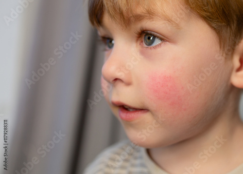 Portrait of a cute little boy with atopic dermatitis on his face