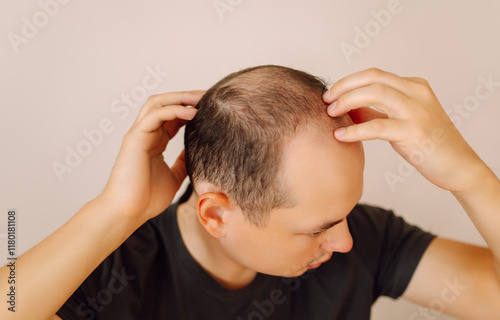 Young caucasian man  worried about balding, close up. Baldness, alopecia in males, male pattern hair loss problem concept. photo