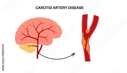 Carotid artery disease