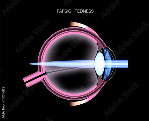 Farsightedness eye disease
