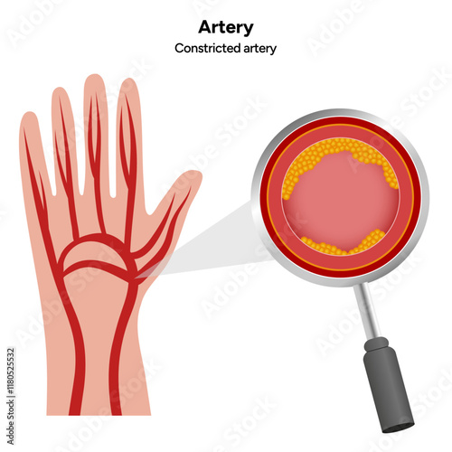 Constricted artery formation of plague, growth and rupture, blood clot and normal artery