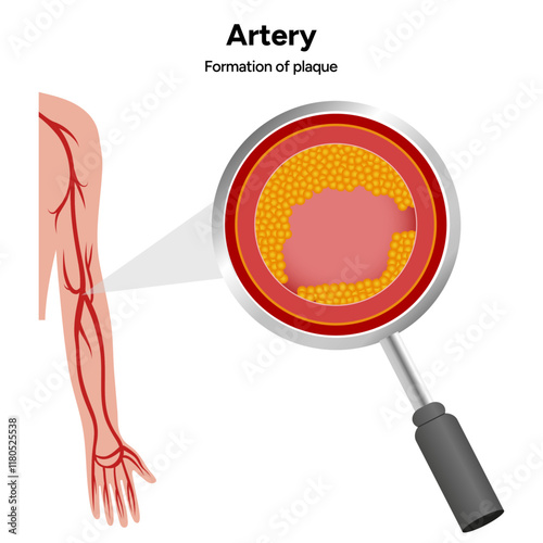 Constricted artery formation of plague, growth and rupture, blood clot and normal artery