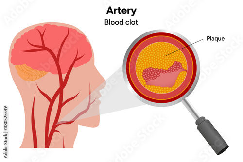 Constricted artery formation of plague, growth and rupture, blood clot and normal artery