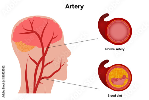 Constricted artery formation of plague, growth and rupture, blood clot and normal artery with head