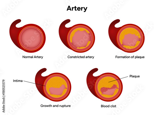 Constricted artery formation of plague, growth and rupture, blood clot and normal artery
