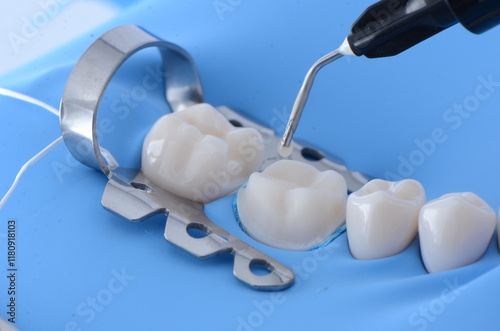 Foto Immediate Dentin Sealing with Rubber Dam
High-quality images showcasing the process of immediate dentin sealing performed under rubber dam isolation