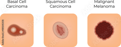 Basal Cell Squamous Cell Malignant Science Design Vector Illustration Diagram