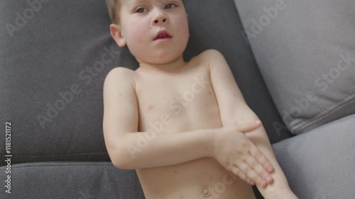 Child battling with chickenpox lying on sofa body with red spots illness boy is sick. Boy is sick with discomfort red spots at whole body sickness Boy is sick chickenpox red spots on body