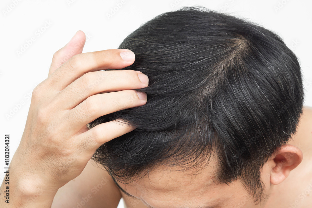 Young man serious hair loss problem for health care medical and shampoo product concept Young man serious hair loss problem for health care medical and shampoo product concept