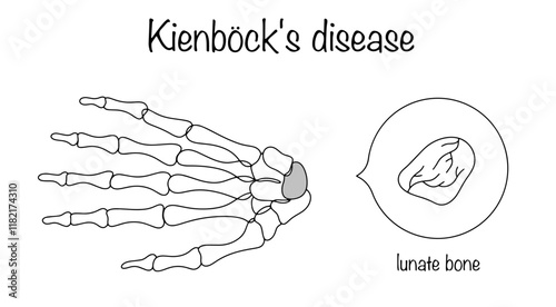 Kienböck's disease