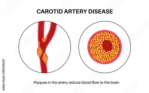 Carotid artery disease