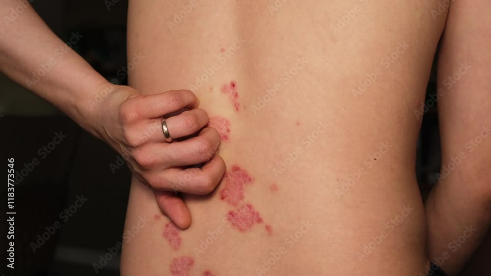 Understanding psoriasis symptoms and management in individuals with skin conditions Understanding psoriasis symptoms and management in individuals with skin conditions