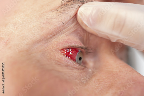 Detailed bloodshot male eye with ruptured blood vessel, emphasizing impact strain on vision, Eye health under scrutiny, Detecting vascular issues photo