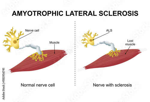 Amyotrophic Lateral Sclerosis ALS Illustration