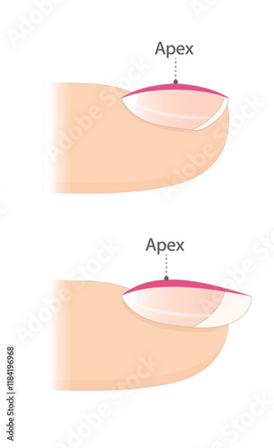 Nail apex. Infographic for nail extension. Manicure. Nail design.