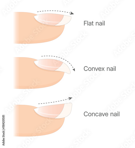 Diagram showing types of nail plate. Flat nail. Convex nail. Concave nail.