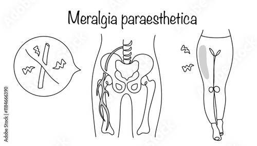 Meralgia paraesthetica