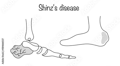 Shinz's disease