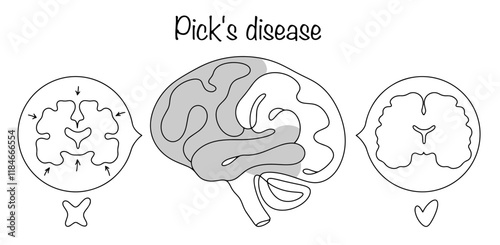 Pick's disease