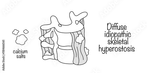 Diffuse idiopathic skeletal hyperostosis