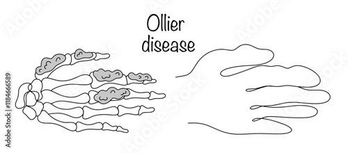 Ollier disease