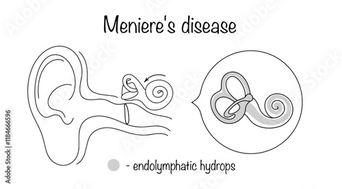 Meniere's disease