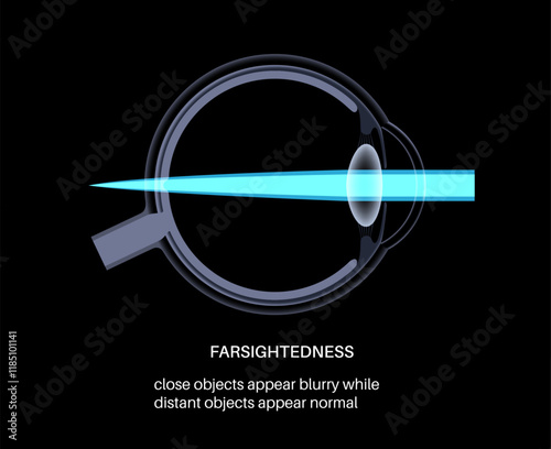 Farsightedness eye disease