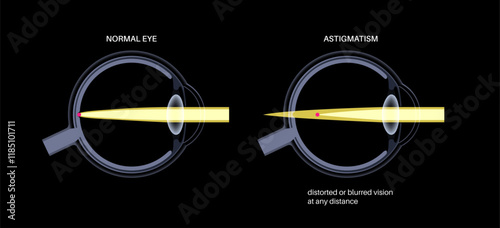Astigmatism eye disease