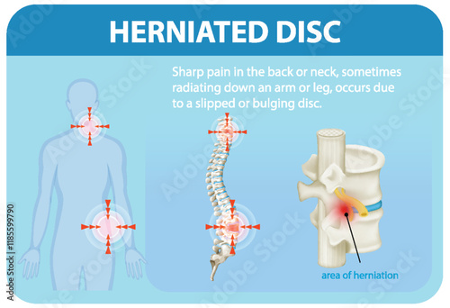 Understanding Herniated Disc Pain