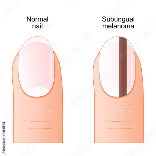 Subungual melanoma. Nail cancer.