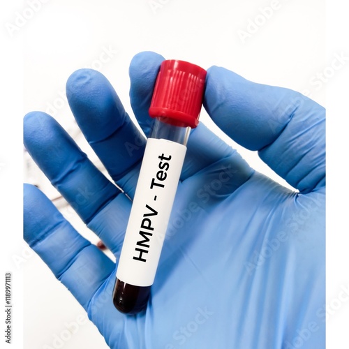 Blood sample for Human Metapneumo virus test, metapneumo virus can cause respiratory disease. RSV. photo