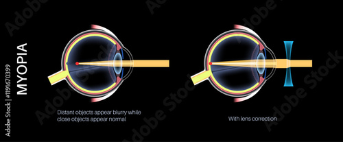 Myopia lens correction