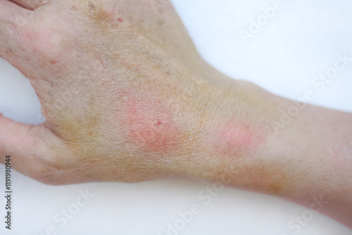 Right hand of Asian woman with red swelling from hornet sting on skin background