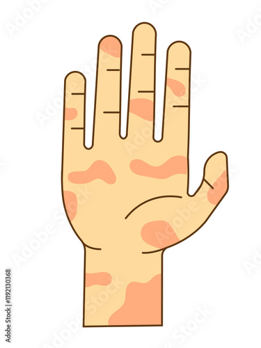 hands with leprosy condition