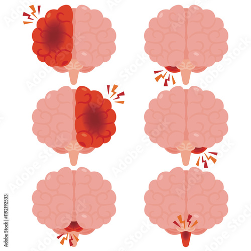 脳出血が起きた脳のイラスト　前視点