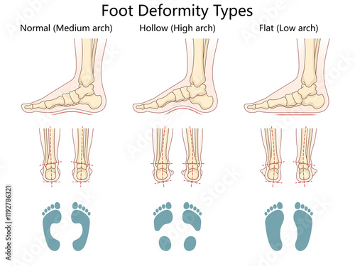 foot deformity types, normal arch, hollow high arch, and flat low arch, anatomical and footprint views diagram hand drawn schematic raster illustration. Medical science educational illustration