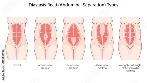 diastasis recti, including around-navel, below-navel, above-navel, and full-length abdominal separations diagram hand drawn schematic raster illustration. Medical science educational illustration photo