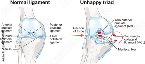 The knee's unhappy triad. Tears of the ACL, MCL, and medial meniscus. Sports injury. Labeled medically illustration photo