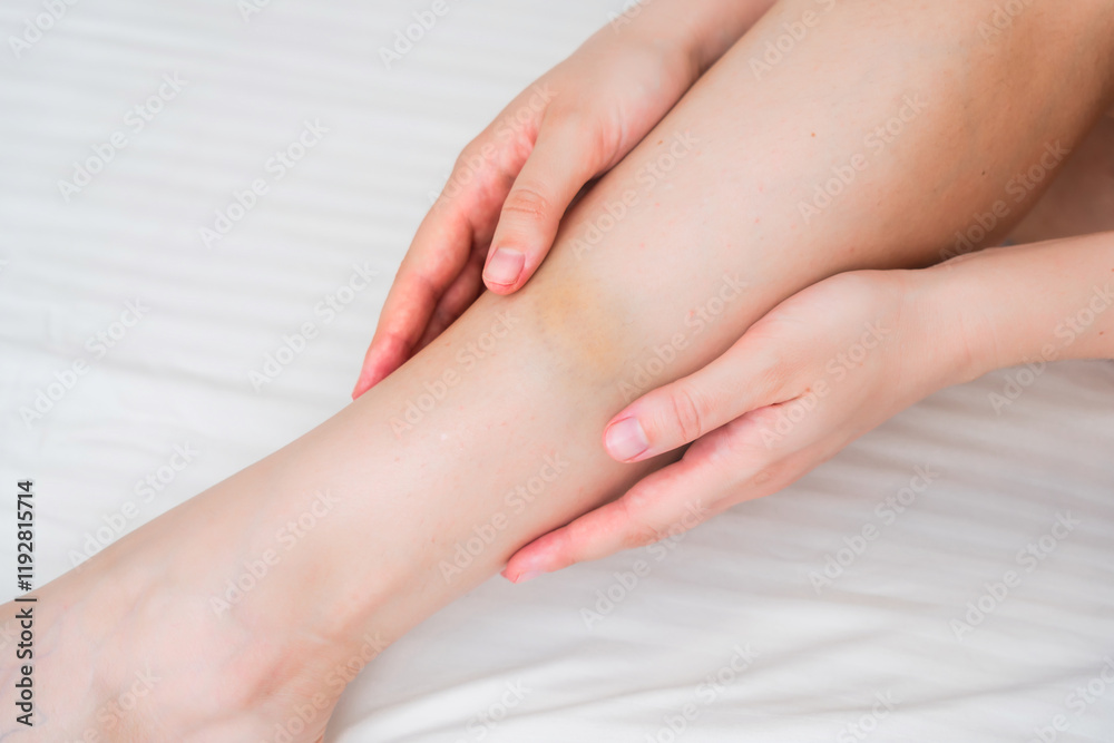 View on the woman leg with bruise, hematoma View on the woman leg with bruise, hematoma