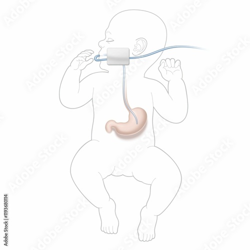 illustration of neonate being fed through nose via a nasogastric or NG tube photo