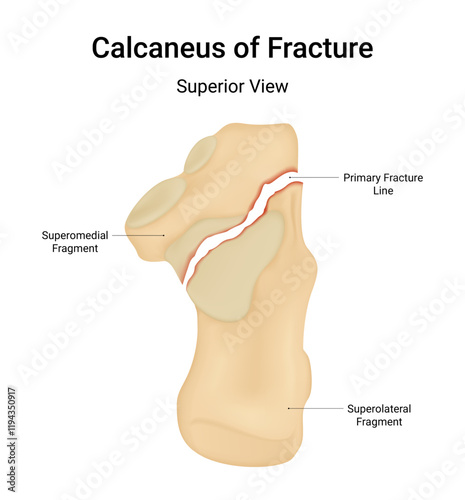 Calcaneus of Fracture Superior View