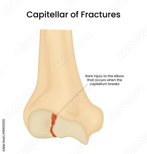 Distal Humerus of Capitellum Fracture