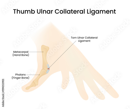 Ulnar Collateral Ligament Injury of the Thumb