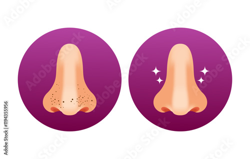 Black Dots on the Nose, Before and After,Healthy Skin and Clean nose