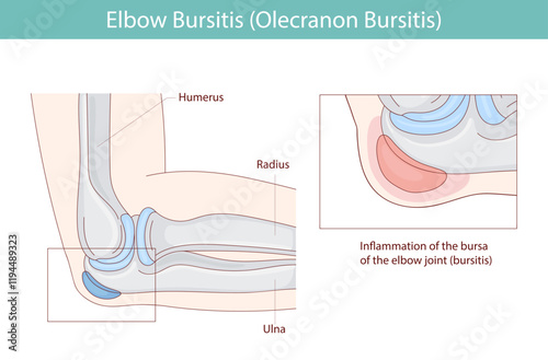 Bursitis of the elbow. Inflammation of the bursa located under the elbow. Vector medical illustration.