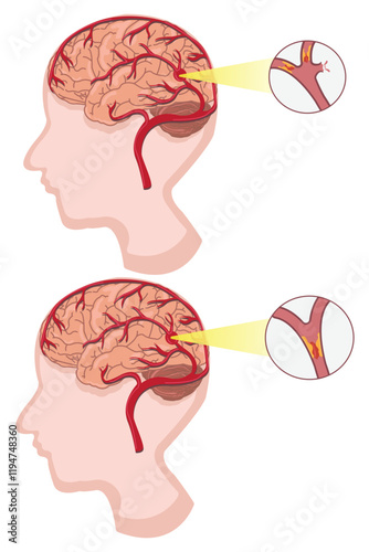 Comparison of ischemic and hemorrhagic stroke, highlighting affected brain blood vessels. eps 10