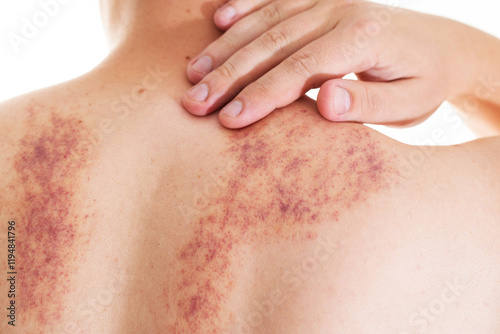 Redness and irritation on the skin of a man s back after a massage. Pimples and red spots with bruises on the skin, close-up