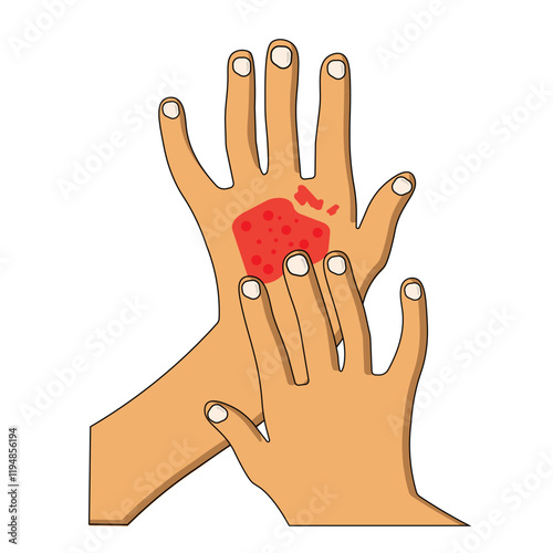 vector illustration of allergen on hands. Allergy, dermatitis, eczema, skin irritation, itchy, dermatology. Isolated on white background