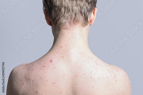 Skin of a teenager's back with acne.