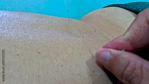 service with acupuncture technique associated with oriental massage